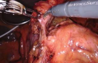 JAMA Surg：腹腔镜vs机器人胃<font color="red">切除术</font>对胃癌患者短期预后的影响