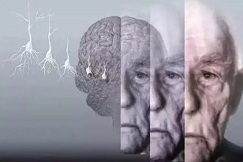 Alzheimers <font color="red">Res</font> <font color="red">Ther</font>：中年时的体重指数与血浆Aβ异常折叠呈负相关