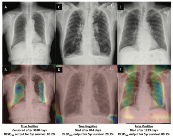 Radiology:深度学习，实现胸片对COPD患者的预后预测！