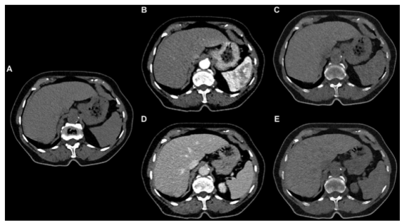 Radiology:VNC腹部成像与光子计数检测器CT
