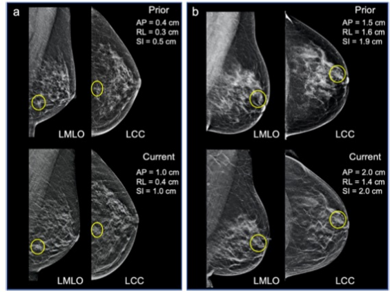 European Radiology:究竟哪个影像学指标可实现浸润性乳腺癌的准确预测？