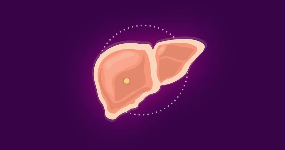 Nature Metabolism：厦门大学吴乔团队揭示肝星状细胞外泌己糖激酶HK1加速肝癌进程新机制