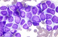 Blood：微小残留病灶可实时预测套细胞淋巴瘤患者预后