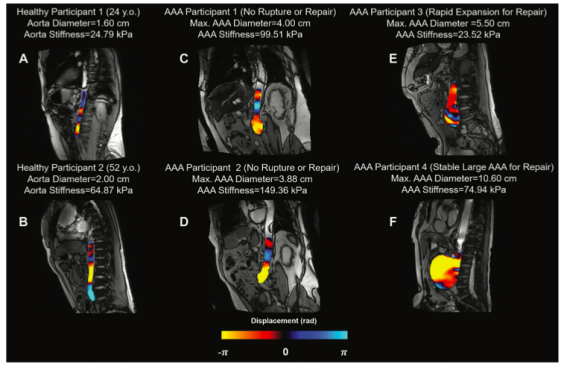Radiology:MR弹性成像在预测腹主动脉瘤破裂中<font color="red">价值</font>