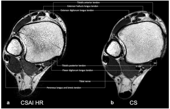 European Radiology:深度学习，给踝关节压缩感知MR成像“加油”！