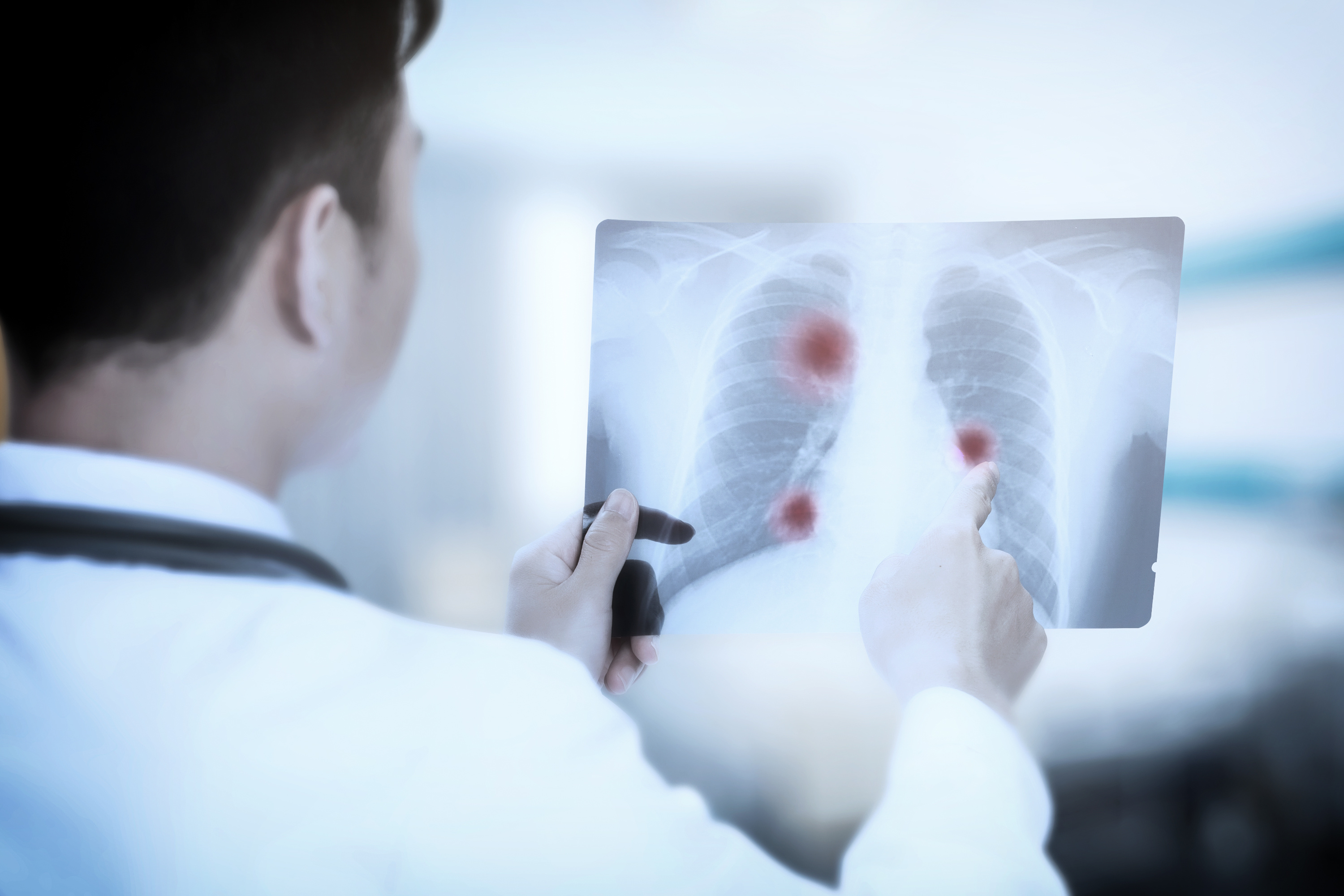 Respir Res：脉冲振荡肺功能在稳定期 COPD 和哮喘患者中长期重复性较高