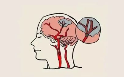 NEJM：经导管主动脉瓣膜置换术过程中脑栓塞保护的效果
