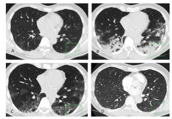 Radiology：基于胸部CT的COVID-19肺炎后1年的预后评估