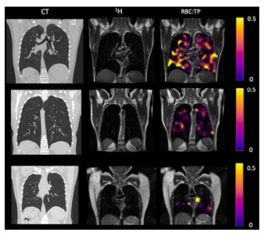 Radiology：超极化<font color="red">氙气</font>MRI显示长期COVID患者的肺部异常
