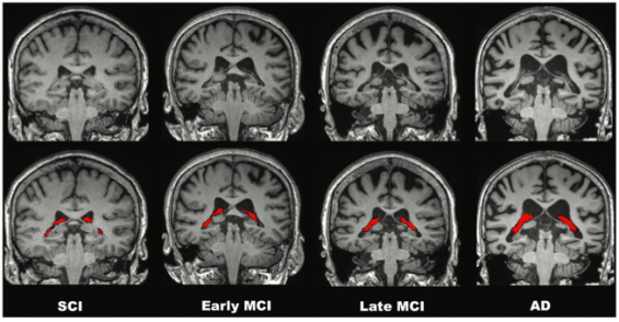 Radiology：颅脑MRI中脉络膜丛体积和<font color="red">通透性</font>在阿尔茨海默病临床频谱中的应用