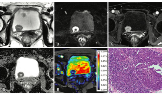 Radiology：酰胺质子转移加权MRI在预测膀胱<font color="red">癌</font>组织学等级中的应用