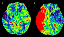 Neurology：急性缺血性脑卒中血管内治疗后的卒中发生时间、<font color="red">侧枝</font>评分和功能结果
