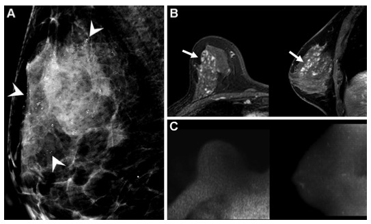 Radiology：乳腺DWI磁共振成像在预测乳腺<font color="red">导管</font>原位癌术前分期中的价值