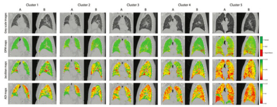 Radiology：重症哮喘表型的定量CT<font color="red">特征</font>