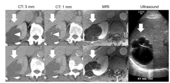 <font color="red">European</font> Radiology：CT薄层图像究竟对Bosniak囊性肾脏肿块分类有何影响？