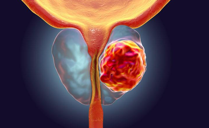 Lancet Oncol：PSMA和FDG-PET可预测转移性去势抵抗性前列腺癌患者的治疗反应