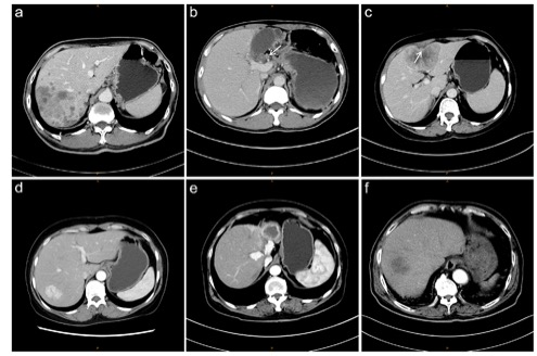 European Radiology：预测肝内肿块型胆管癌患者预后的CT影像学表现列线图
