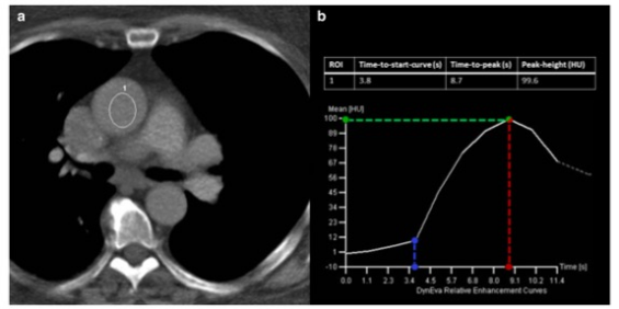 European Radiology：基于机器学习的冠状动脉CTA增强不足的预测