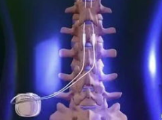 JAMA：高频刺激疗法治疗腰椎手术后慢性神经根疼痛