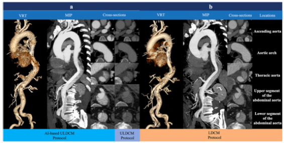 European Radiology：如何又好又多的减少主动脉CT血管成像的<font color="red">造影</font>剂用量？