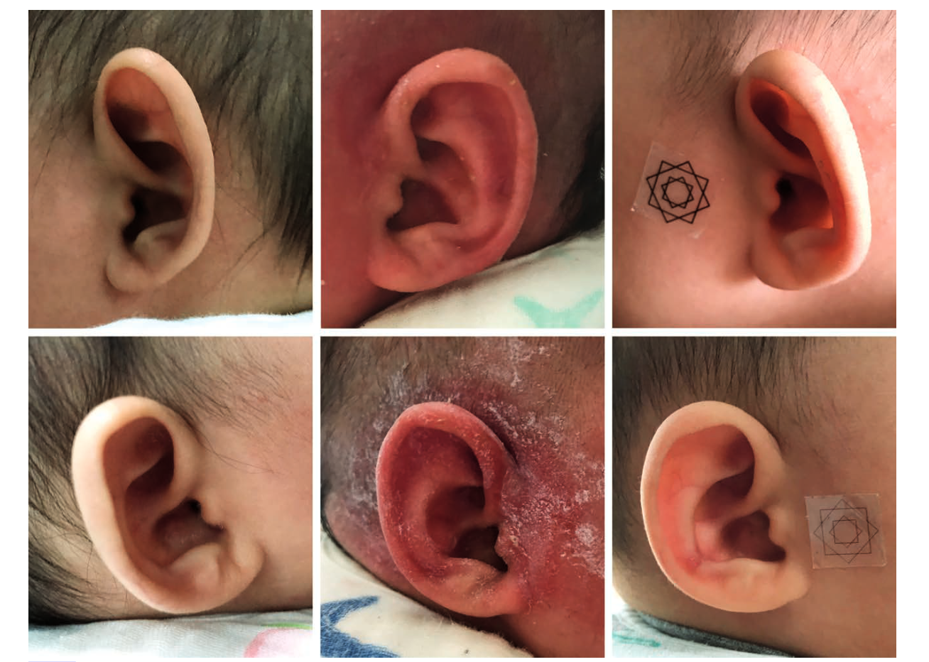 耳廓形态畸形治疗新方法——耳廓矫形器 - 好大夫在线