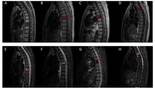 European Radiology：估转移性肺腺癌患者EGFR和T790M突变的MRI放射<font color="red">组</font><font color="red">学</font>列线图