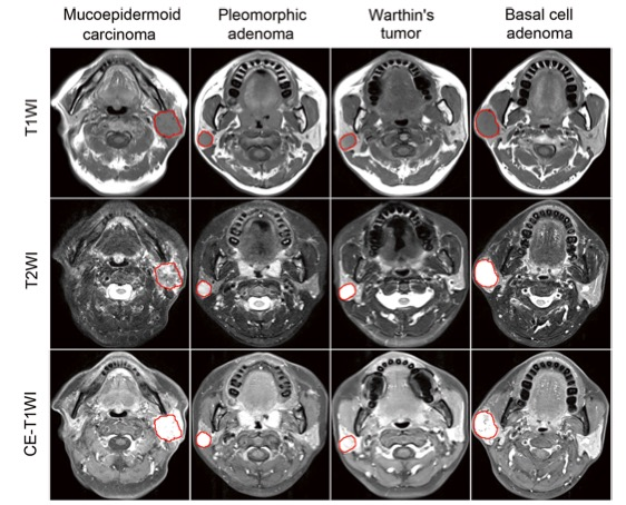 European Radiology：基于机器学习的腮腺肿瘤MRI组织学分类的比较