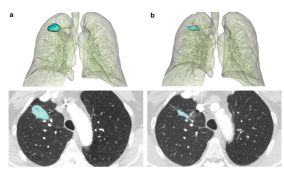 European Radiology：肺部肿瘤经<font color="red">皮</font>微波和冷冻消融治疗后的影像学表现