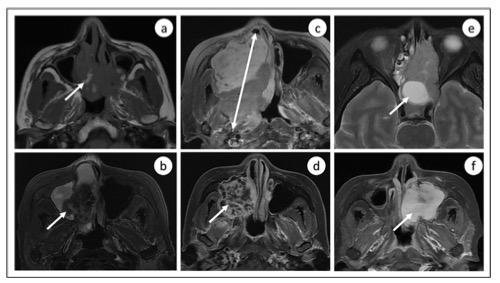 European Radiology：多参数MRI放射组学在术前预测鼻窦恶性肿瘤Ki-67增殖状态中的应用