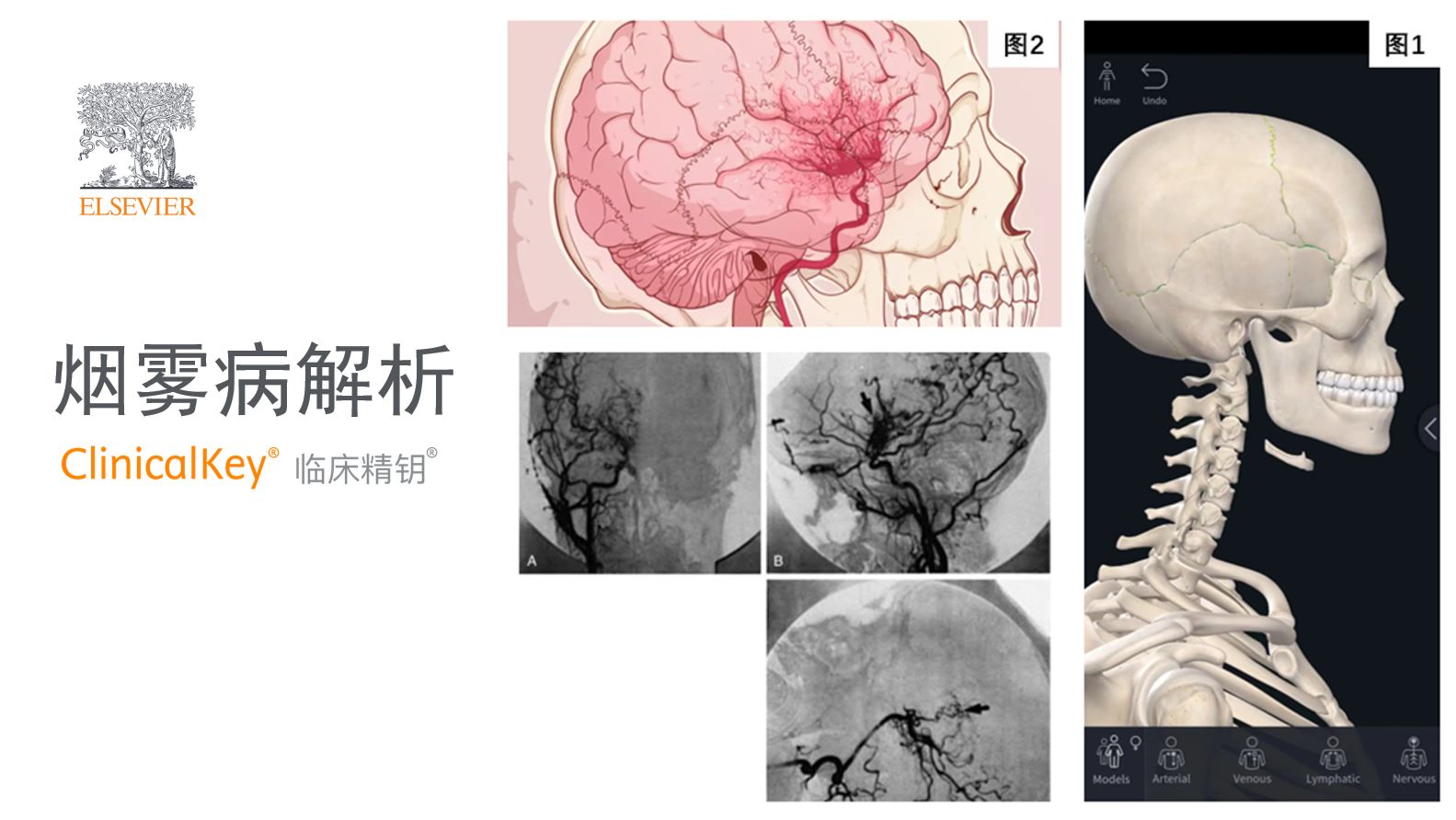 ClinicalKey临床<font color="red">精</font>钥解读“烟雾病”