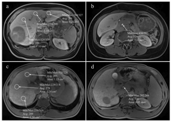 European Radiology：Gd-BOPTA增强肝胆造影在预测肝癌患者肝切除术后肝功能衰竭中的价值