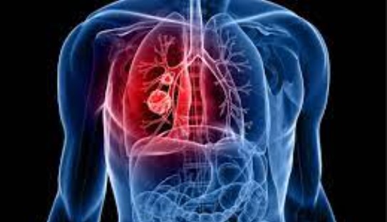 BMJ | 哈佛研究：胸部CT筛查与<font color="red">肺癌</font>分期更早、转移更少、<font color="red">死亡</font>更低有关！