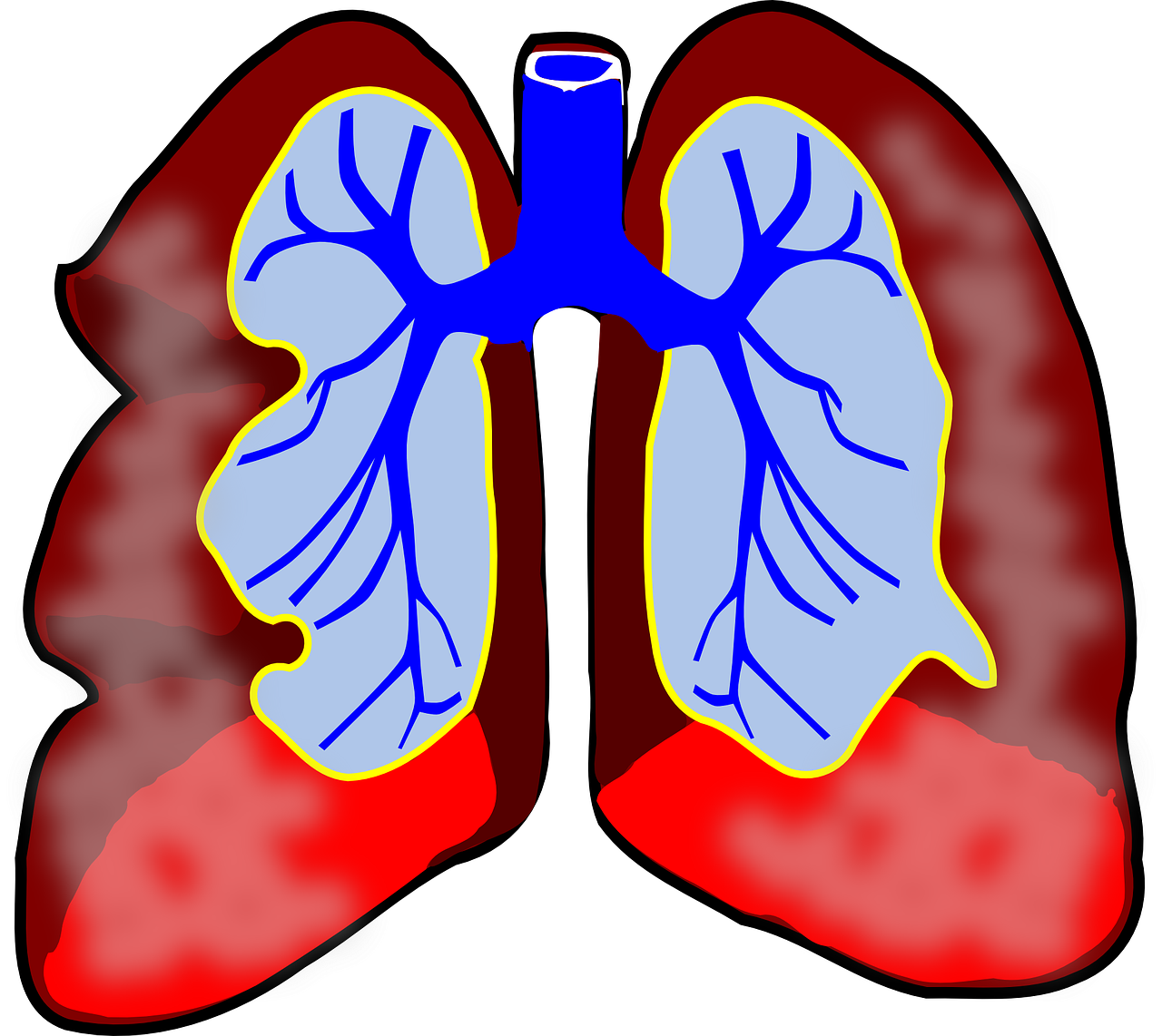 Lancet子刊：评价tezepelumab对激素依赖型哮喘患者的激素节约效应，来自SOURCE 3期研究结果