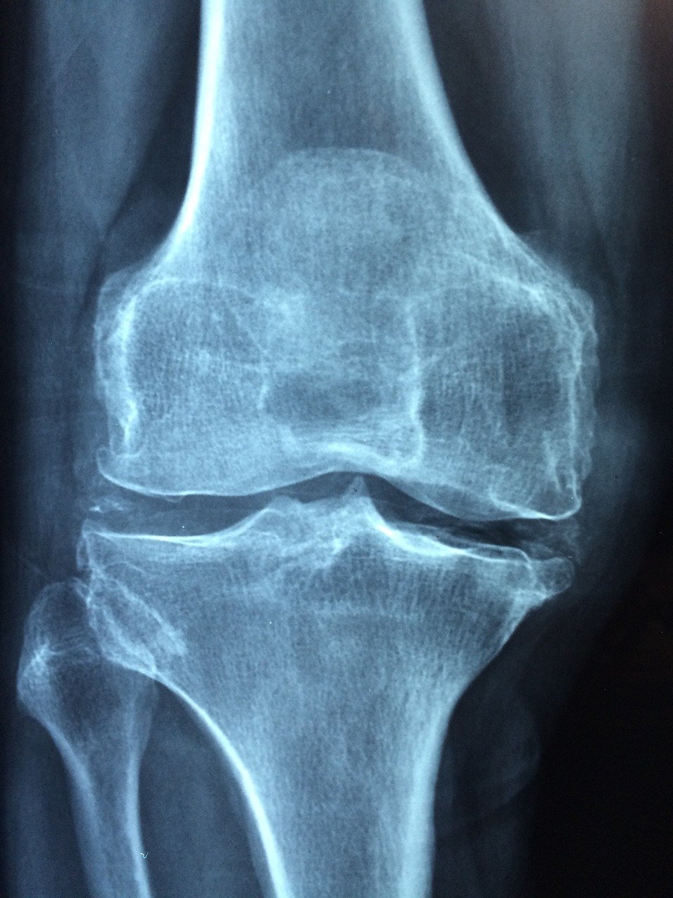 2021 AAOS临床实践指南：膝关节骨关节炎的管理（非关节成形术）-第3版