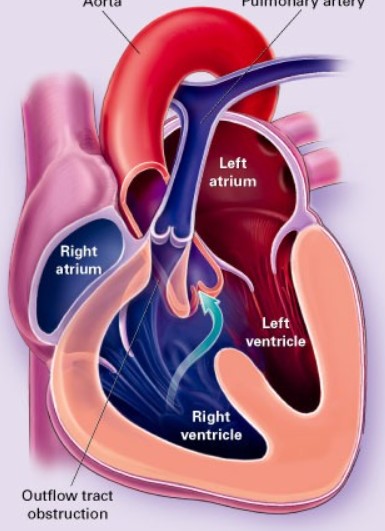 JACC：成人先天性心脏病患者左<font color="red">心室</font>收缩功能障碍的患病率和预后影响