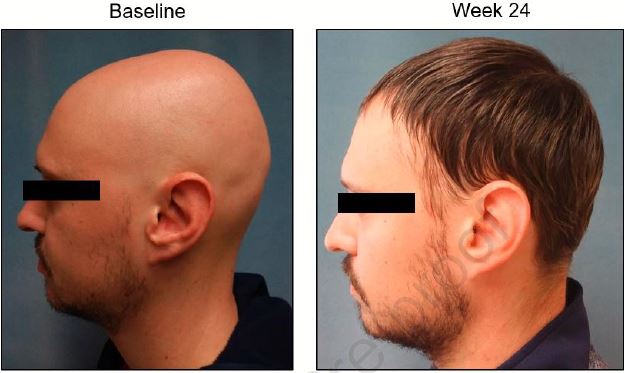 JAAD：新型氘化JAK抑制剂CTP-543治疗中重度斑秃的效果