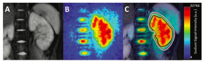 Radiology：功能钠MRI<font color="red">技术</font>在肾功能方面的应用