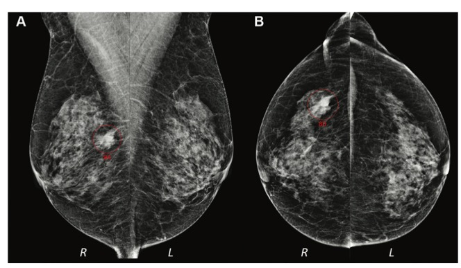 Radiology：利用<font color="red">人工</font>智能实现对间隔期乳腺癌的检测