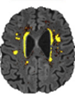 Biological Psychiatr：不同大脑<font color="red">状态</font>的时间占比失衡是 cSVD 相关认知下降的标志