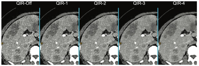 Radiology：<font color="red">光子</font>计数检测器CT的横空出世，为图像质量带来哪些优势？