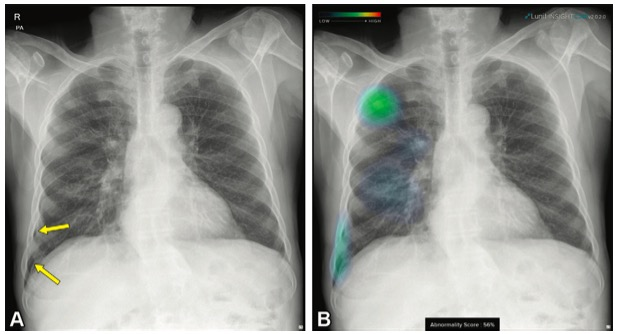 Radiology：深度学习在PTNB后气胸检测上的<font color="red">应用</font>