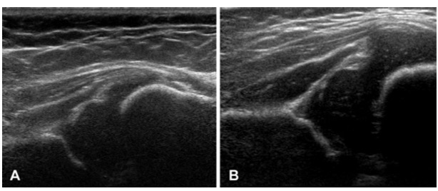 Radiology：统计形状建模的US图像预测在<font color="red">髋关节</font><font color="red">发育不良</font>中的应用