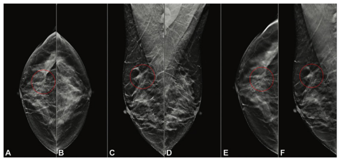 Radiology：人工智能，为女性乳腺癌筛查“减负”！