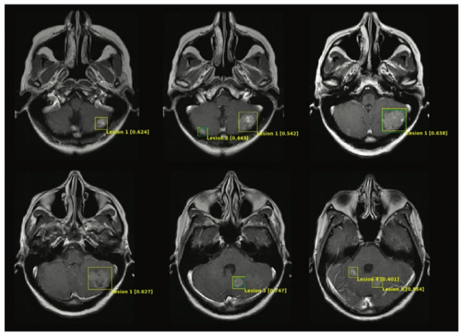 Radiology：脑MRI肿瘤检测模型的半监测训练