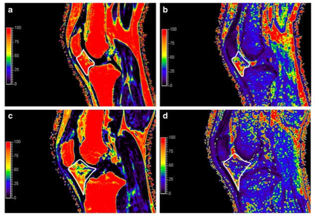 European Radiology：膝关节骨关节<font color="red">炎</font>髌下脂肪垫的定量MR评价