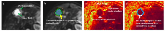 European Radiology：MRE在评估HCC微血管<font color="red">侵犯</font>中的应用