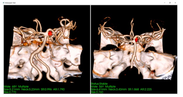 European Radiology：基于深度学习的颅内动脉瘤破裂预测