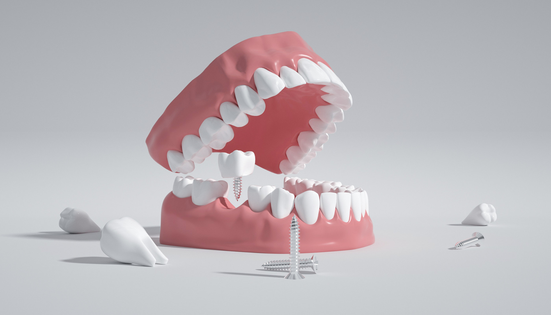 Clin Oral Investig：牙齿蛀掉了，纳米羟基磷灰石能恢复吗？