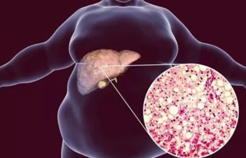 美国心脏协会（AHA）：影响全球1/4成人，脂肪肝风险不止肝癌，主要死因居然还有冠心病！