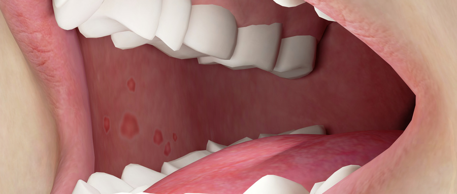 J Clin Periodontol：荟萃分析结果显示，补充或通过饮食摄入欧米茄-3脂肪酸可有效改善牙周炎病情
